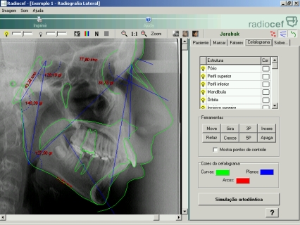 Cefalometria computadorizada - Tela Radiocef Viewer