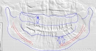 software laudo implante textura